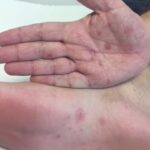 Infecções silenciosas podem comprometer fertilidade e deixar sequelas permanentes